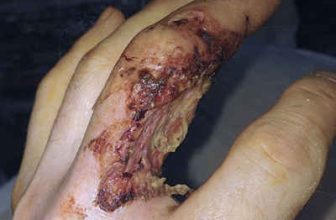 Cover your cuts!